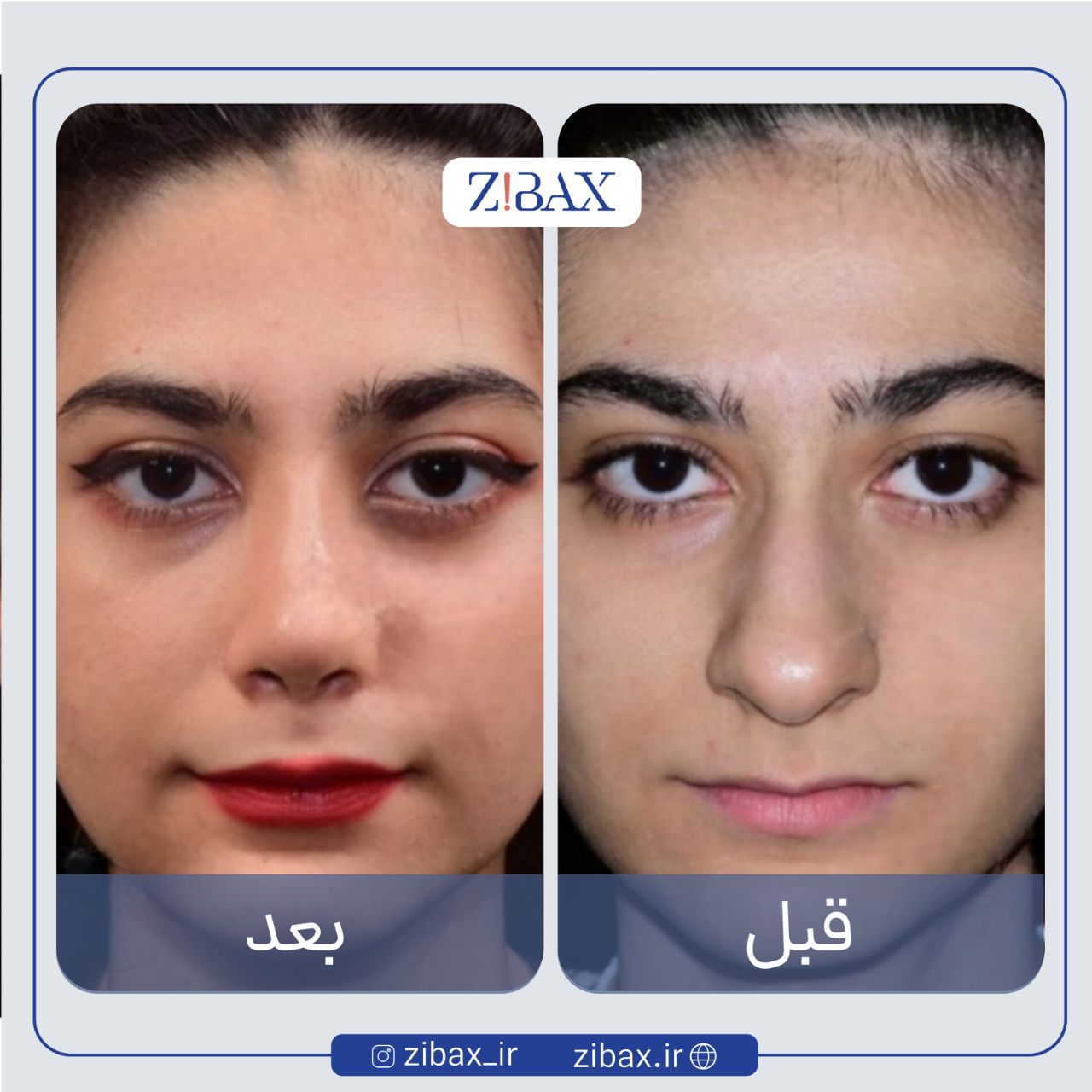 نتیجه جراحی