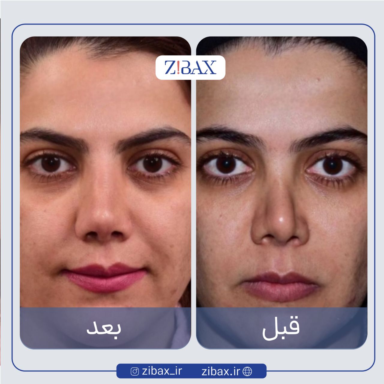 نتیجه جراحی