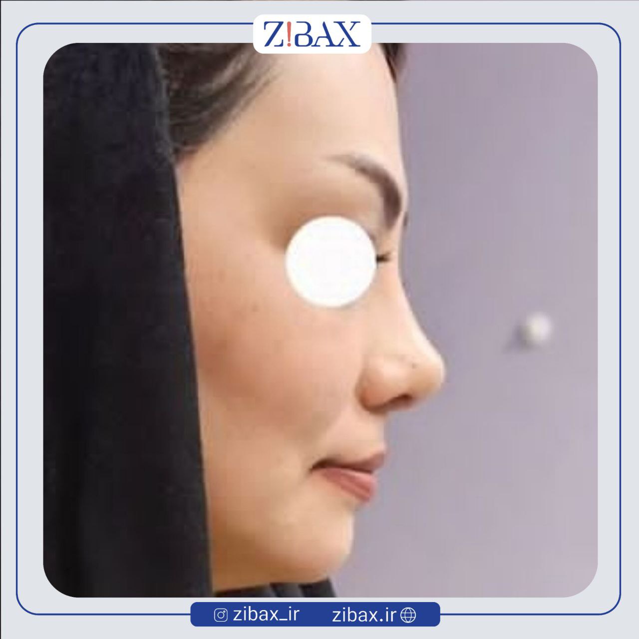 نمونه عمل جراحی بینی دکتر سیده نفیسه خلیلی — تصویر 1