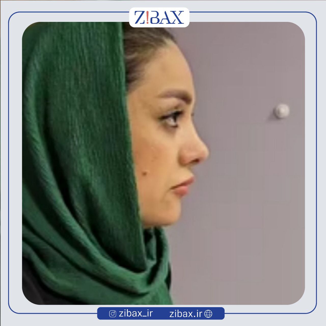 نمونه عمل جراحی بینی دکتر سیده نفیسه خلیلی — تصویر 2