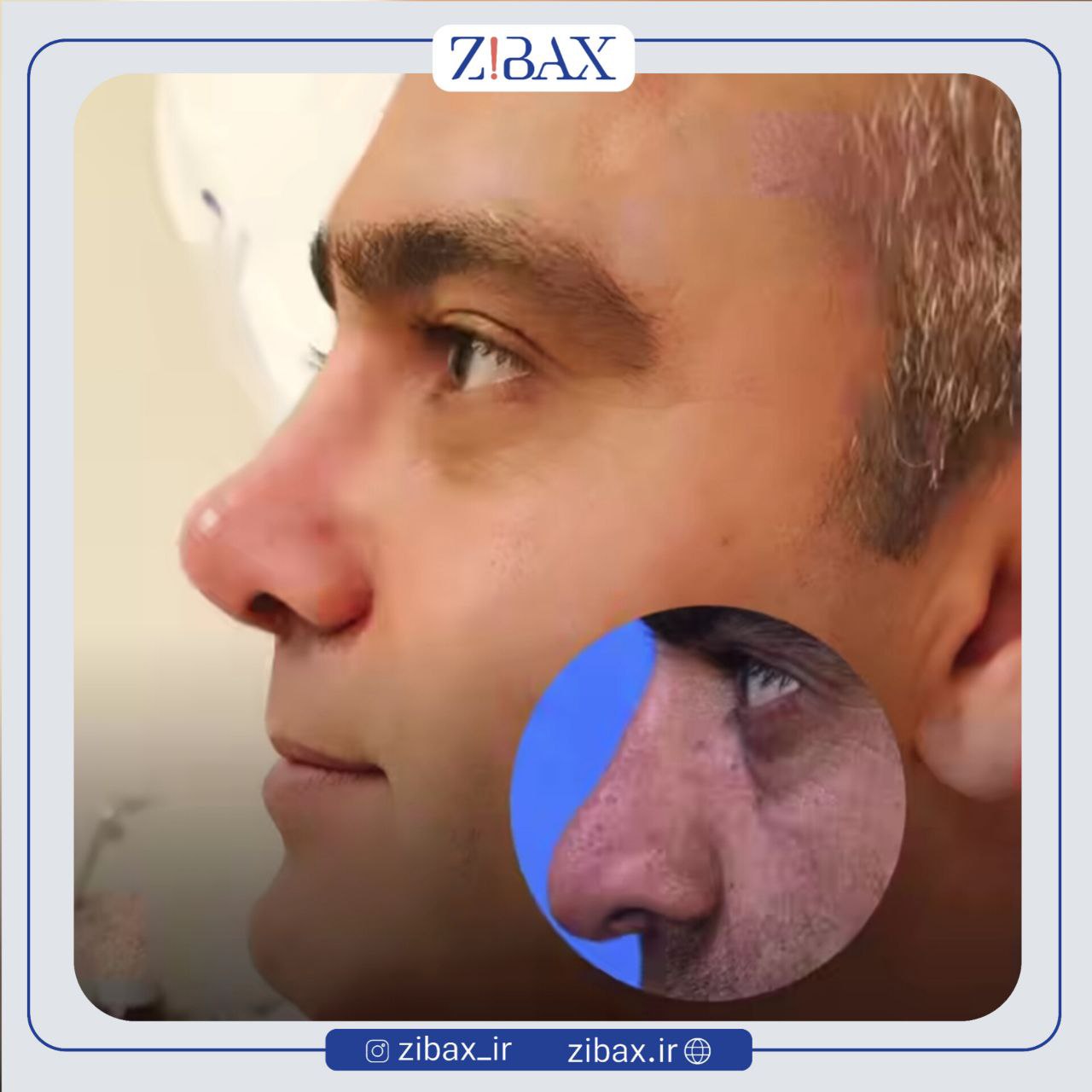 نمونه عمل جراحی بینی دکتر سیده نفیسه خلیلی — تصویر 4