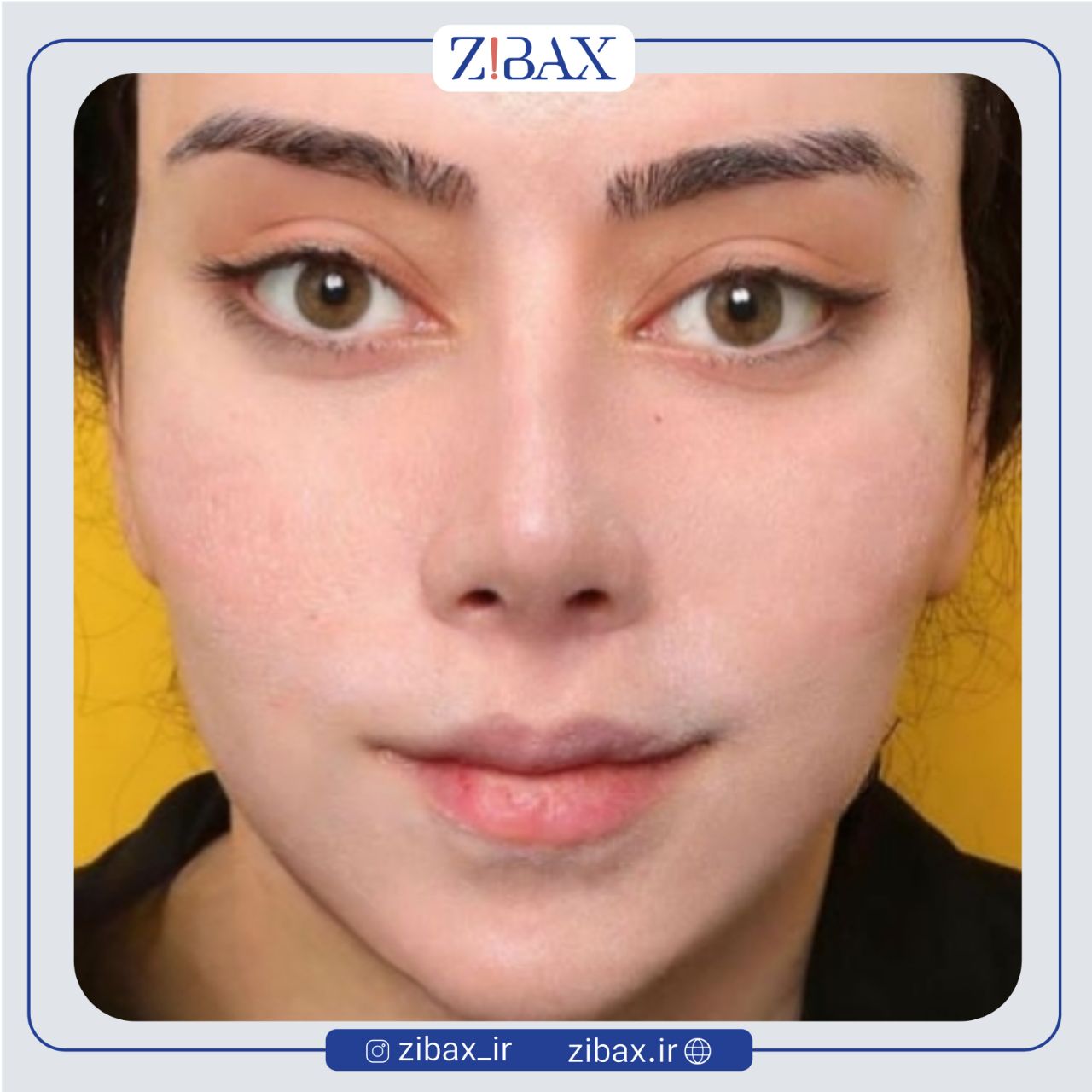 نمونه عمل جراحی بینی دکتر مهدی احمدی — تصویر 1