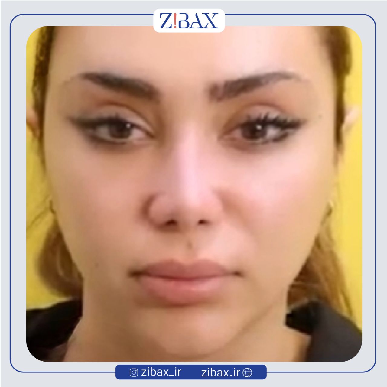 نمونه عمل جراحی بینی دکتر مهدی احمدی — تصویر 2