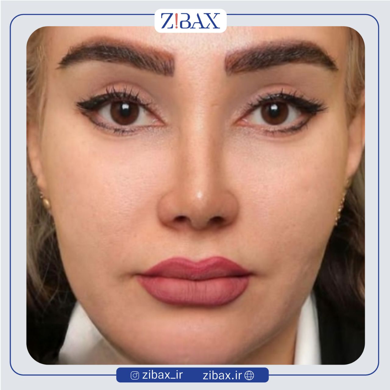 نمونه عمل جراحی بینی دکتر مهدی احمدی — تصویر 4