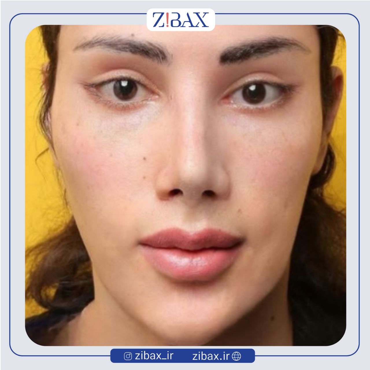 نمونه عمل جراحی بینی دکتر مهدی احمدی — تصویر 7