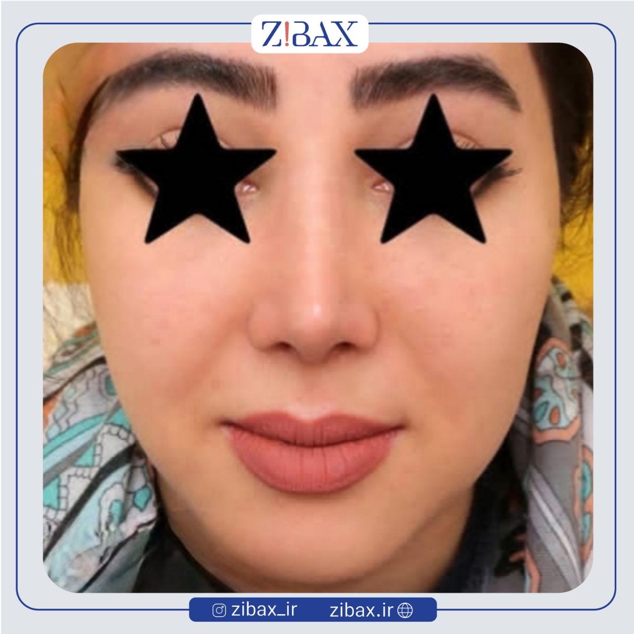 نمونه عمل جراحی بینی دکتر مهدی احمدی — تصویر 9