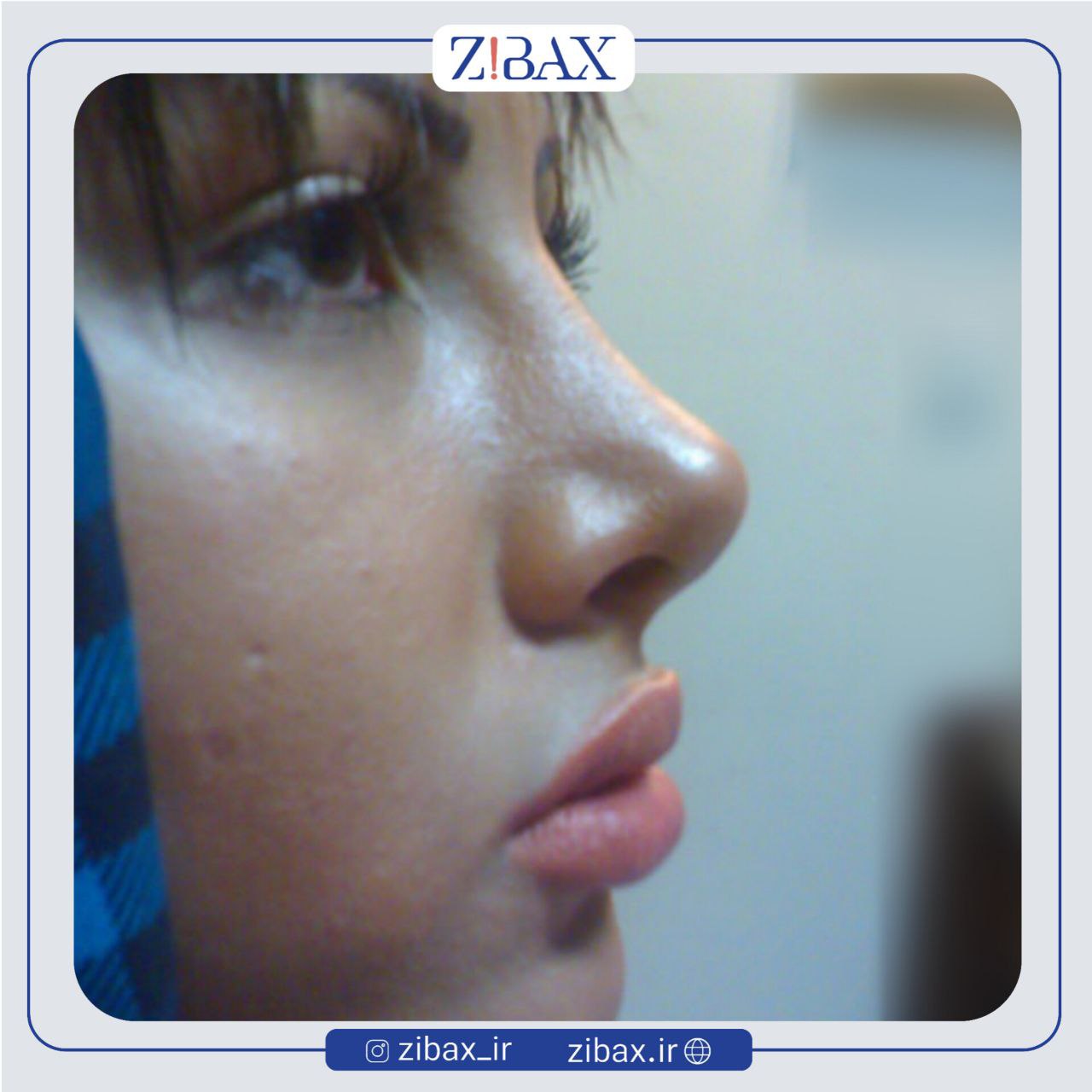نمونه عمل جراحی بینی دکتر جابر قرشی — تصویر 1