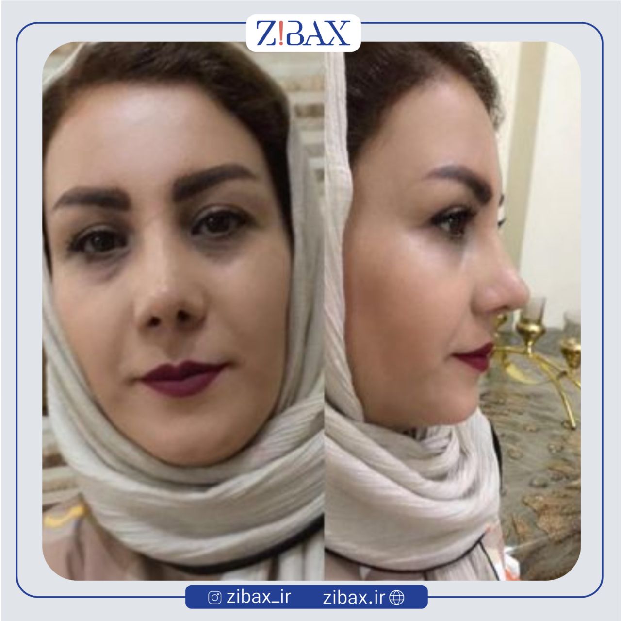 نمونه عمل جراحی بینی دکتر مرتضی جوادی — تصویر 1
