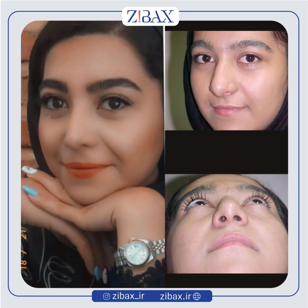 نمونه عمل جراحی بینی دکتر مرتضی جوادی — تصویر 3