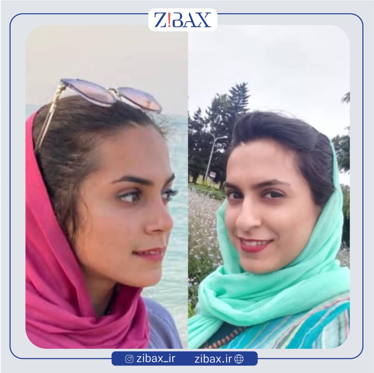 نمونه عمل جراحی بینی دکتر مرتضی جوادی — تصویر 6