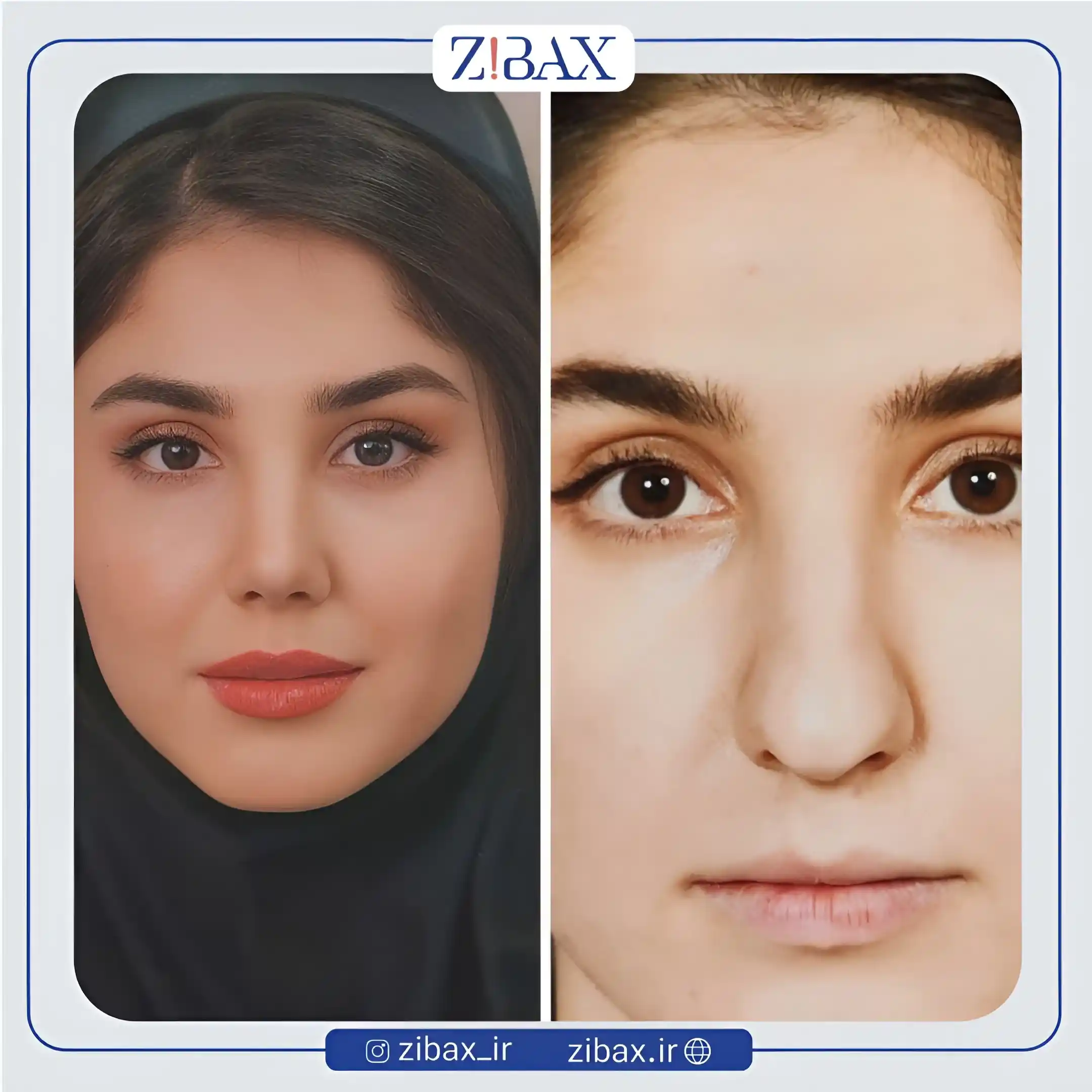نمونه عمل جراحی بینی دکتر محسن بهادر — تصویر 6