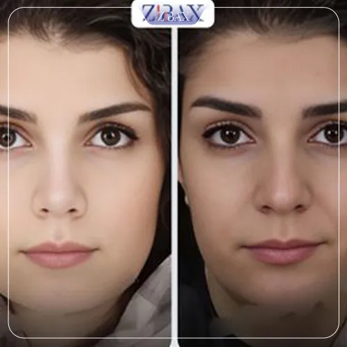 نمونه عمل جراحی بینی دکتر پارسا چراغی پور — تصویر 5