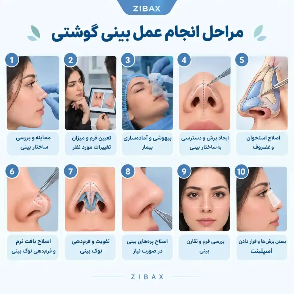 مراحل عمل کردن بینی گوشتی