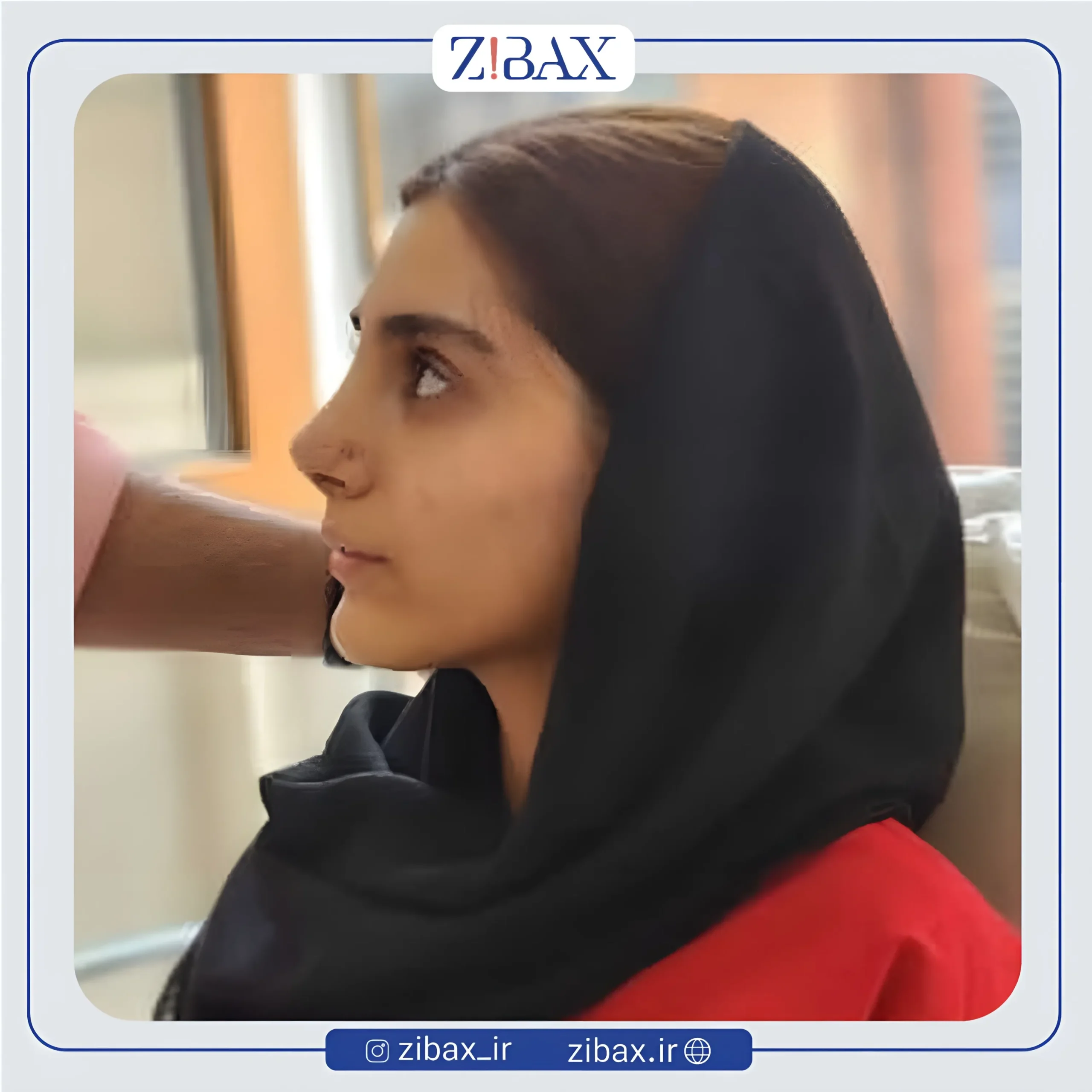 نمونه عمل جراحی بینی دکتر حمیدرضا راستی — تصویر 2