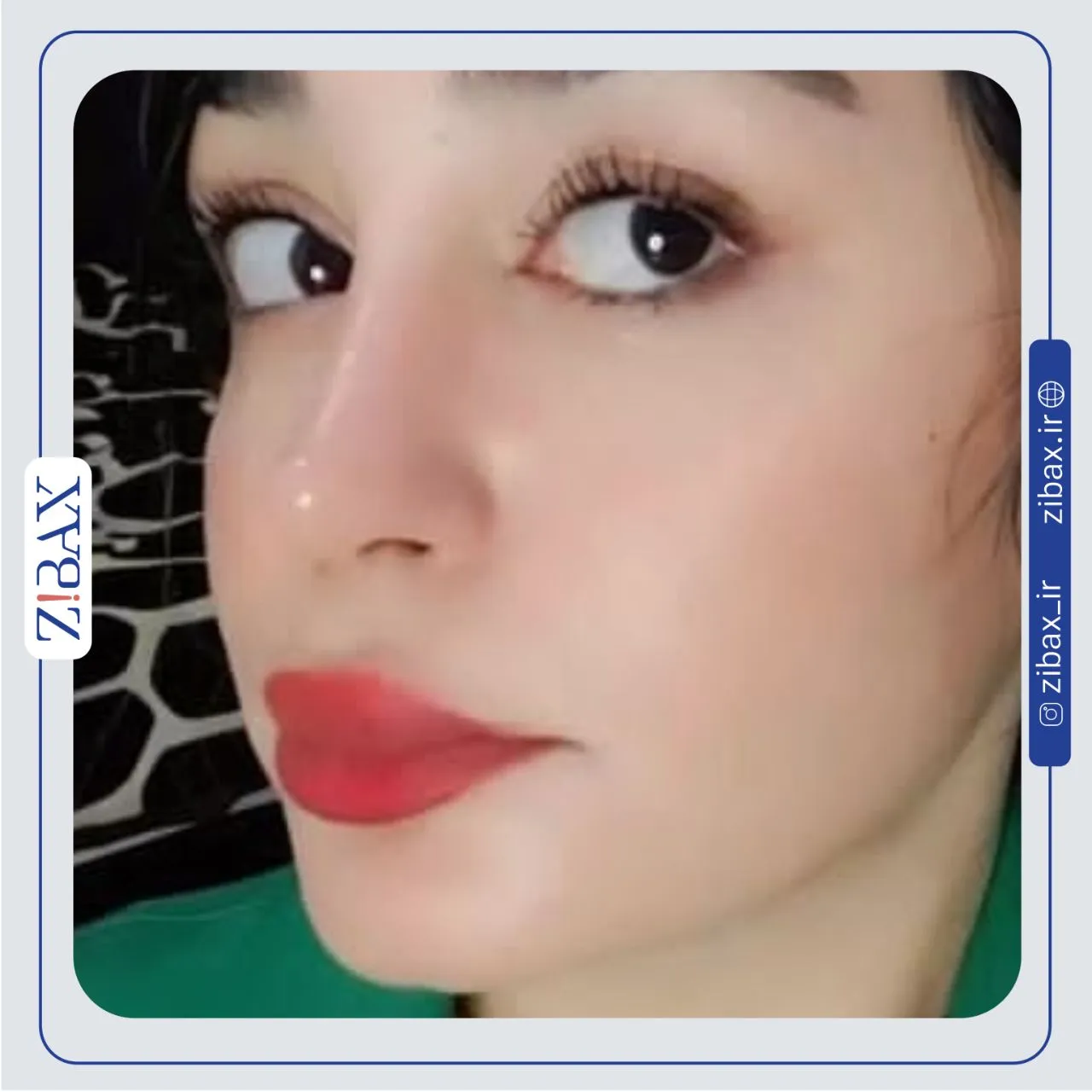نمونه عمل جراحی بینی دکتر امین میراحمدی — تصویر 10