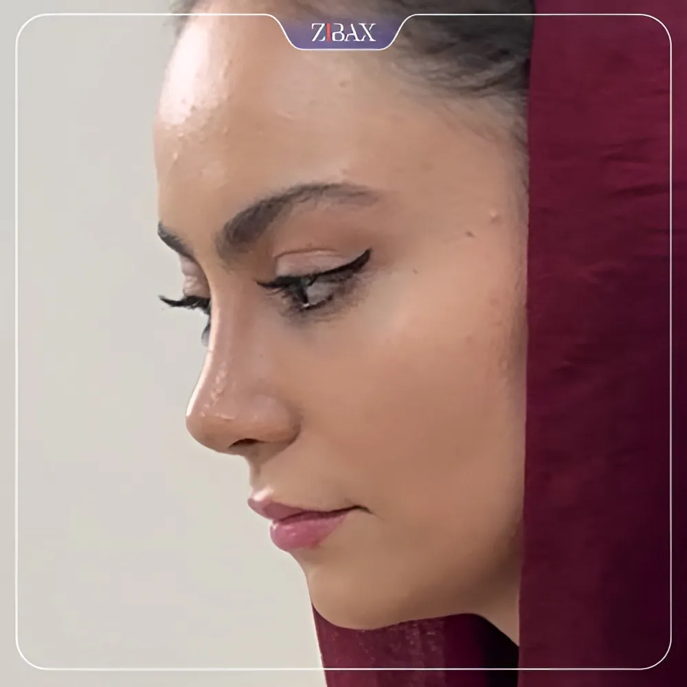 نمونه عمل جراحی بینی دکتر آرزو خوانساری نیا — تصویر 8