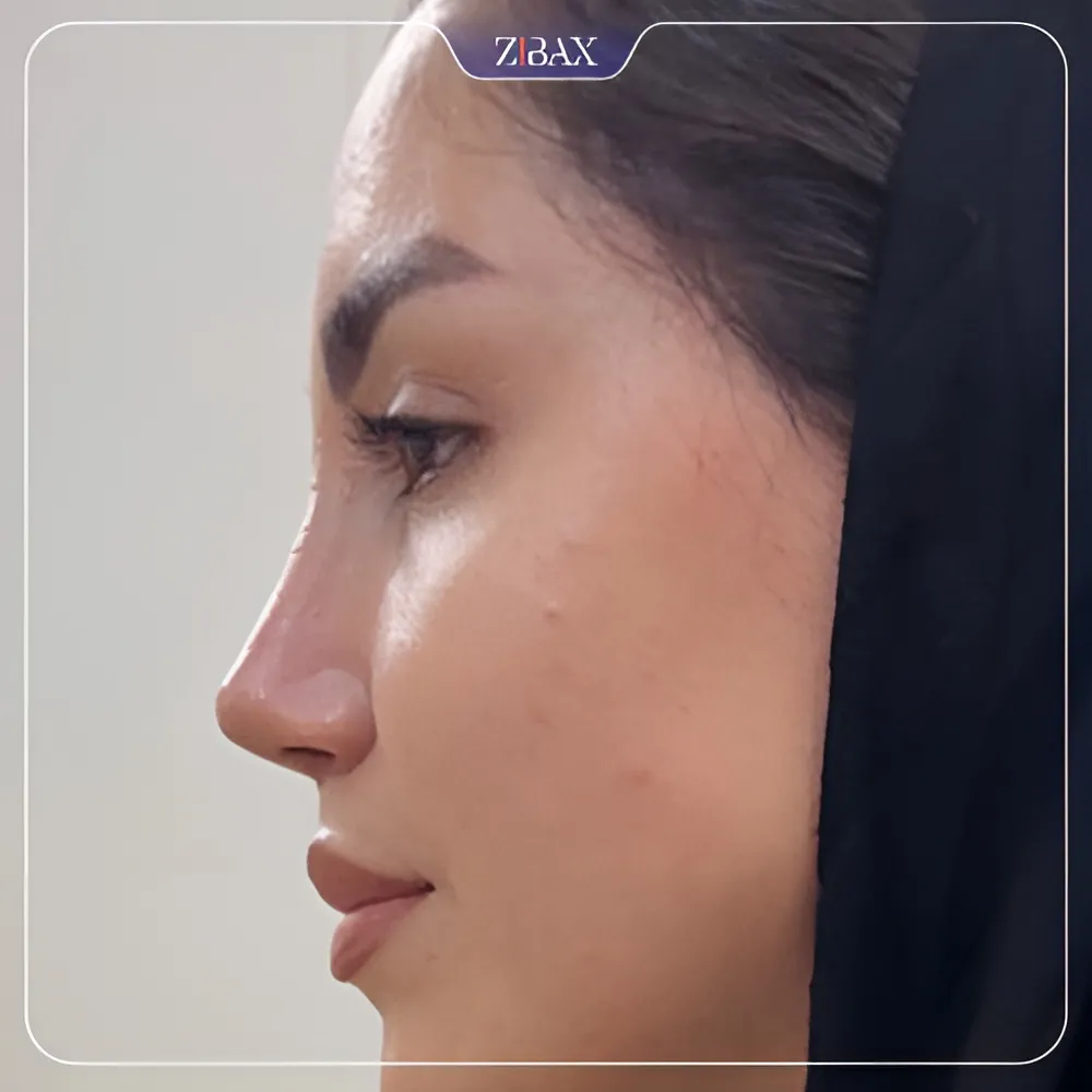 نمونه عمل جراحی بینی دکتر آرزو خوانساری نیا — تصویر 9