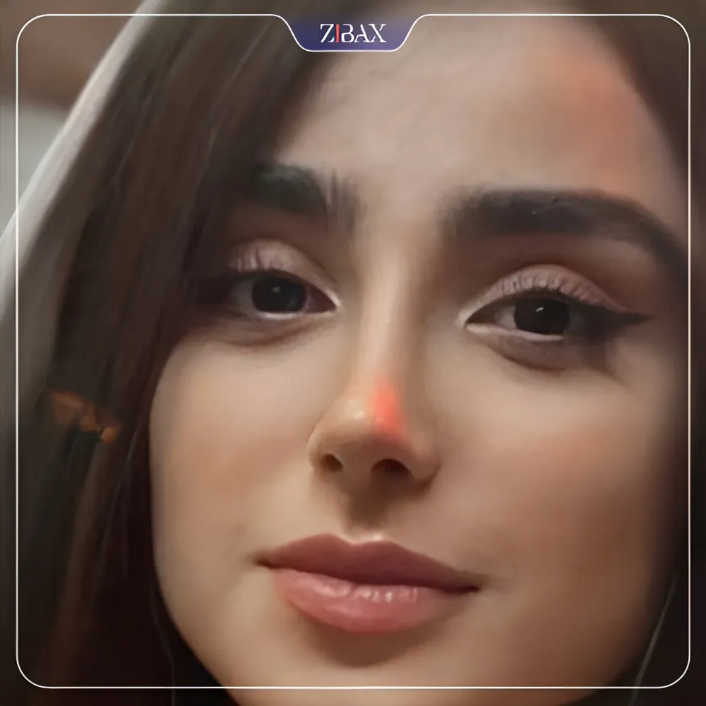 نمونه عمل جراحی بینی دکتر آرزو خوانساری نیا — تصویر 10