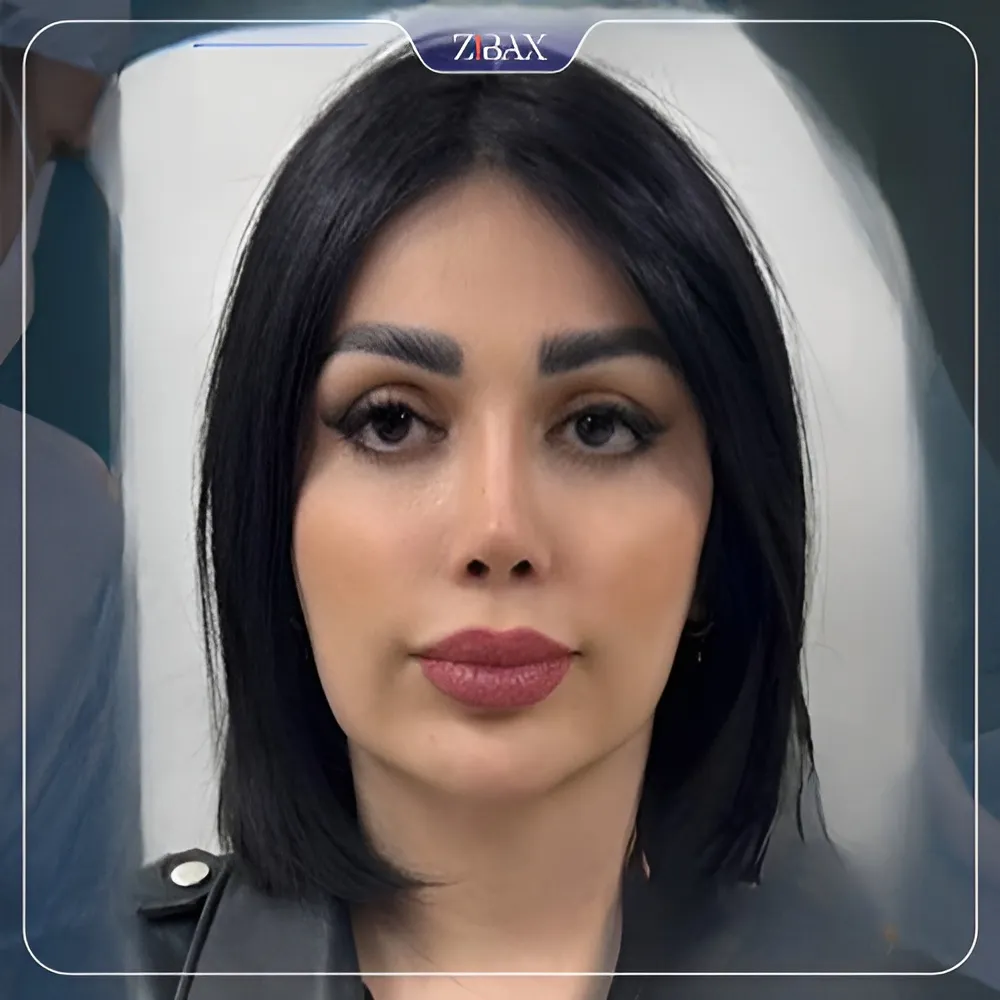نمونه عمل جراحی بینی دکتر آرزو خوانساری نیا — تصویر 5