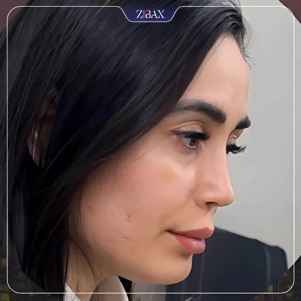 نمونه عمل جراحی بینی دکتر آرزو خوانساری نیا — تصویر 1
