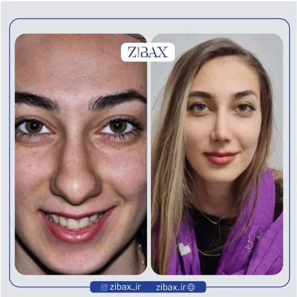 نمونه عمل جراحی بینی دکتر علی شفیعی — تصویر 5