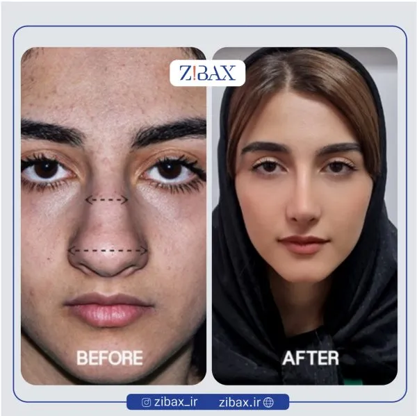 نمونه عمل جراحی بینی دکتر علی شفیعی — تصویر 7