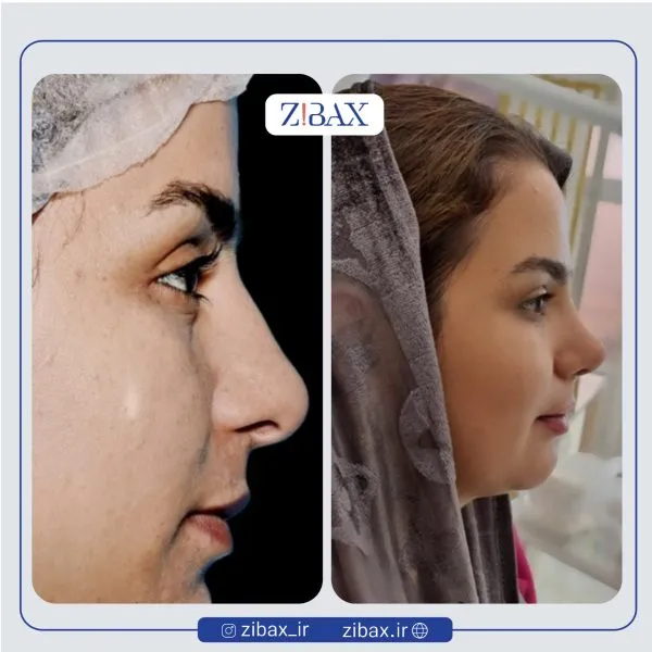 نمونه عمل جراحی بینی دکتر علی شفیعی — تصویر 9