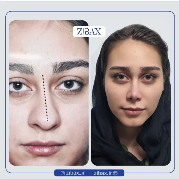 نمونه عمل جراحی بینی دکتر علی شفیعی — تصویر 10