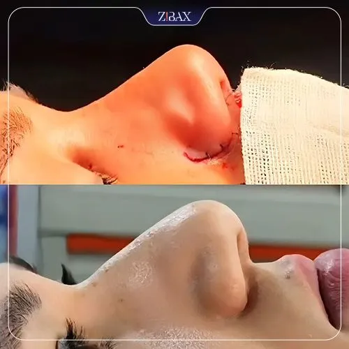 نمونه عمل جراحی بینی دکتر محمد بلاغی اینالویی — تصویر 1