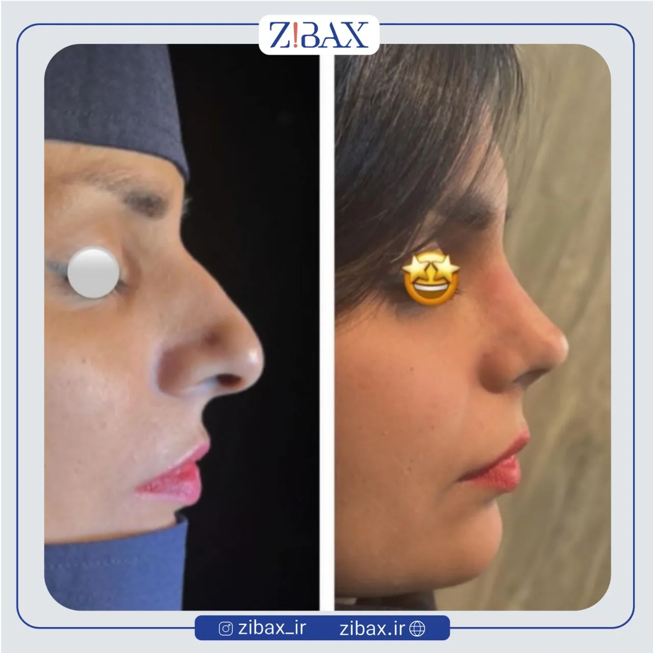 نمونه عمل جراحی بینی دکتر امین میراحمدی — تصویر 5