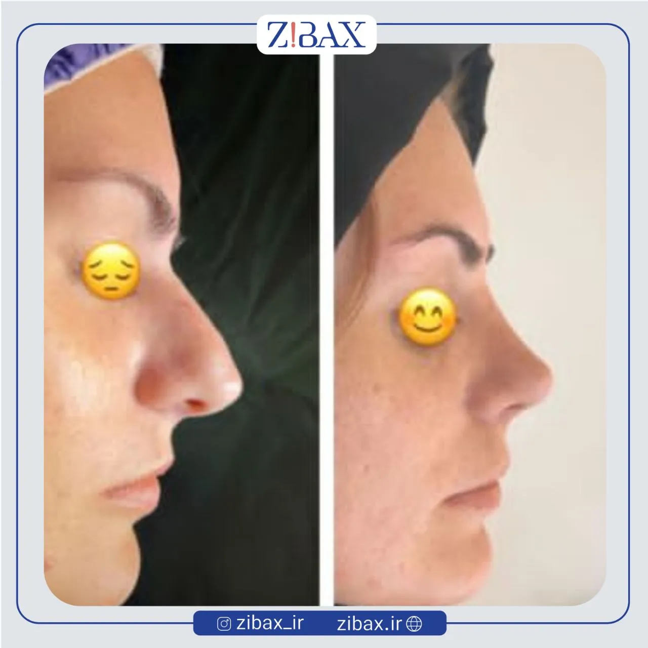 نمونه عمل جراحی بینی دکتر امین میراحمدی — تصویر 2