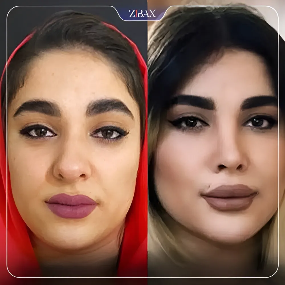 نمونه عمل جراحی بینی دکتر زهرا خسروی — تصویر 8