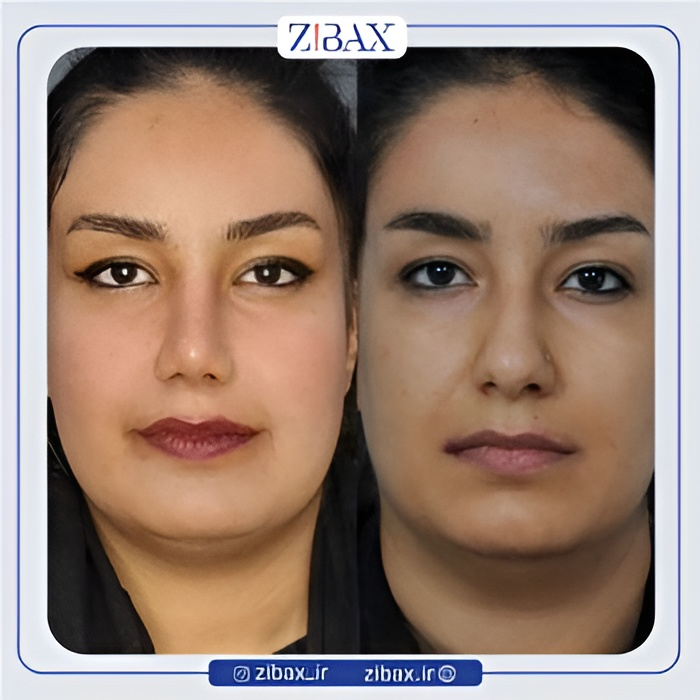 نمونه عمل جراحی بینی دکتر سعیدرضا توفیقی — تصویر 2