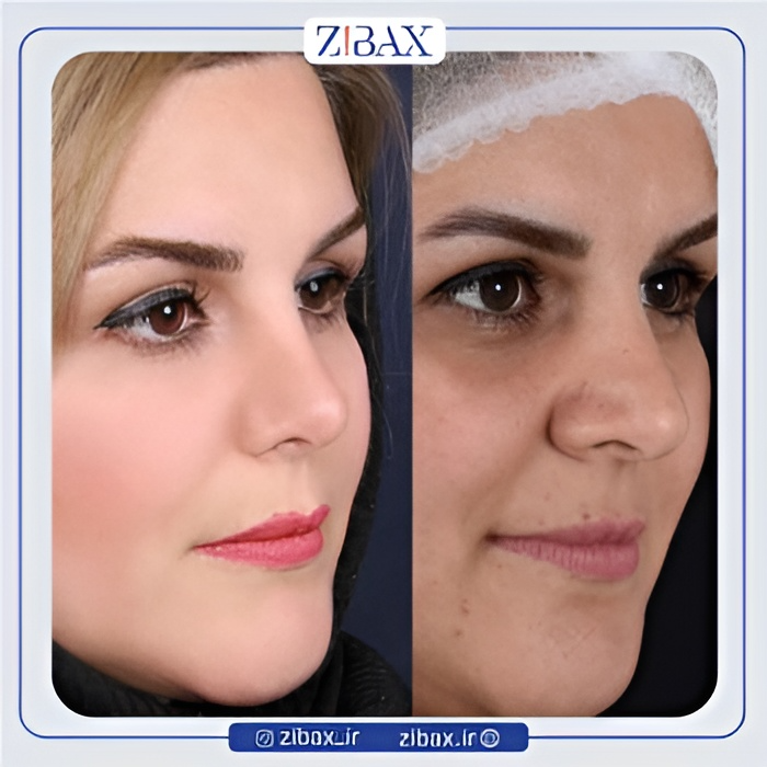 نمونه عمل جراحی بینی دکتر سعیدرضا توفیقی — تصویر 1