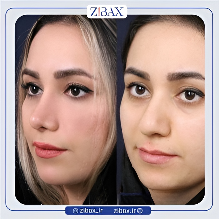 نمونه عمل جراحی بینی دکتر سعیدرضا توفیقی — تصویر 10