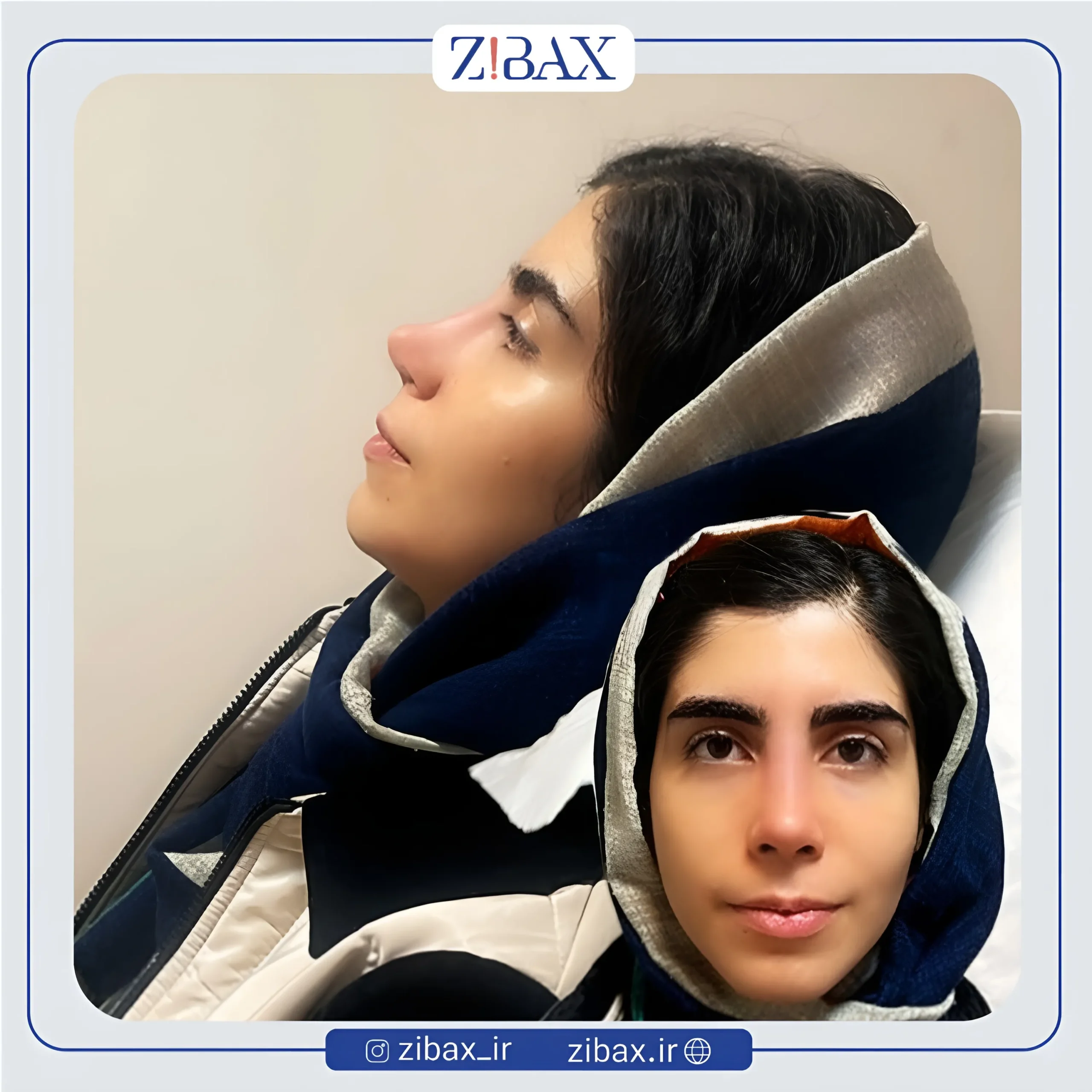 نمونه عمل جراحی بینی دکتر حمیدرضا راستی — تصویر 3