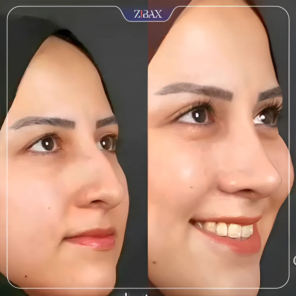 نمونه عمل جراحی بینی دکتر محمد باقر بخشی پور — تصویر 1