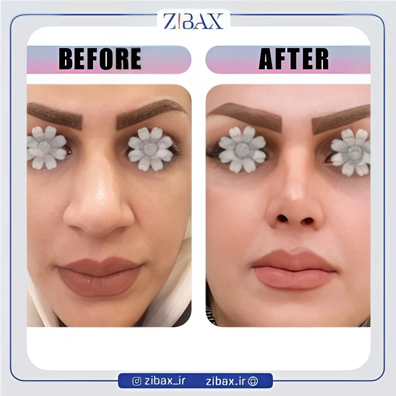 نمونه عمل جراحی بینی دکتر مینا جمالی — تصویر 4