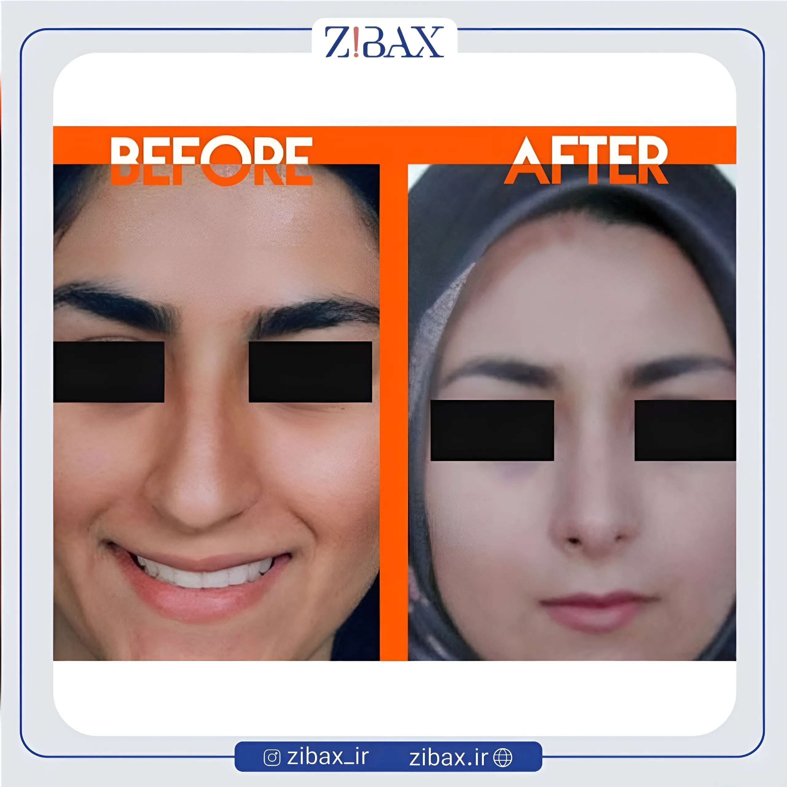 نمونه عمل جراحی بینی دکتر محمدرضا توکلی — تصویر 8