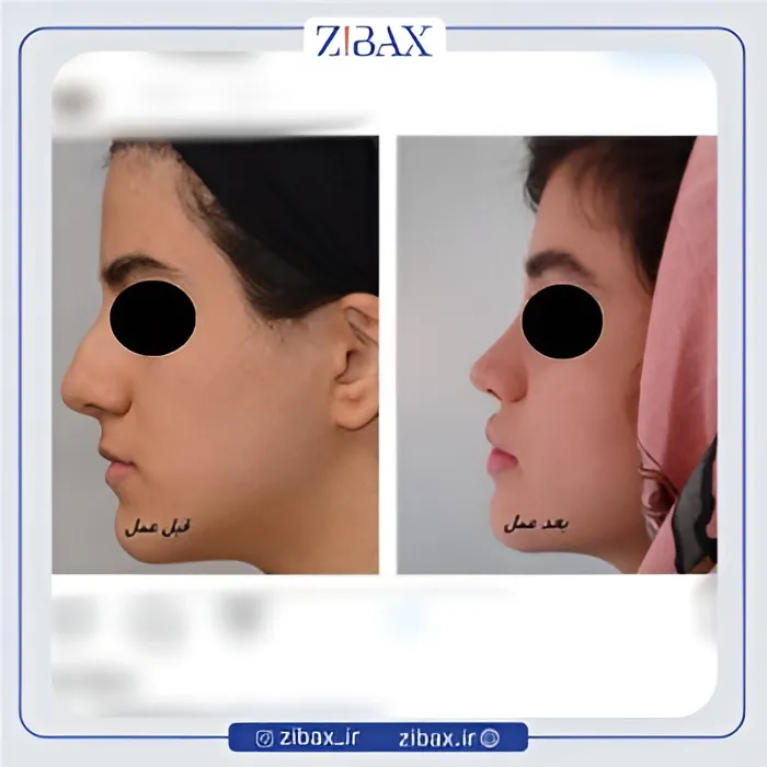 نمونه عمل جراحی بینی دکتر عبدالرسول صادقیان — تصویر 1
