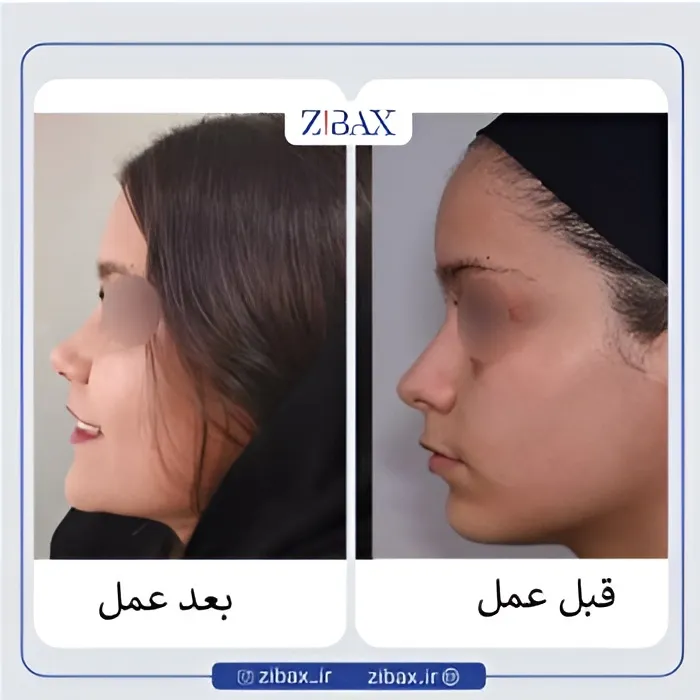 نمونه عمل جراحی بینی دکتر عبدالرسول صادقیان — تصویر 2