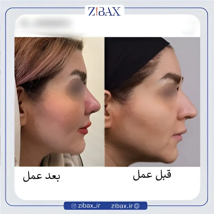 نمونه عمل جراحی بینی دکتر عبدالرسول صادقیان — تصویر 4