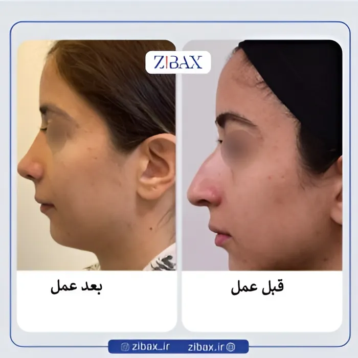 نمونه عمل جراحی بینی دکتر عبدالرسول صادقیان — تصویر 7