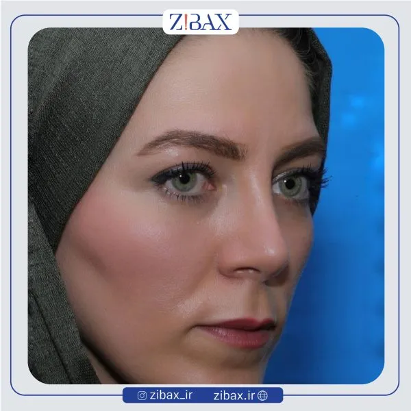 نمونه عمل جراحی بینی دکتر علیرضا عالیان — تصویر 7