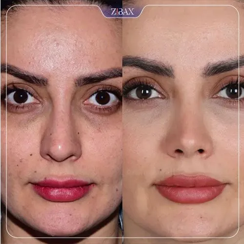 نمونه عمل جراحی بینی دکتر امین آمالی — تصویر 5