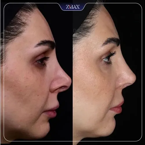 نمونه عمل جراحی بینی دکتر امین آمالی — تصویر 4
