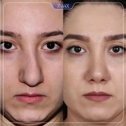 نمونه عمل جراحی بینی دکتر امین آمالی — تصویر 7