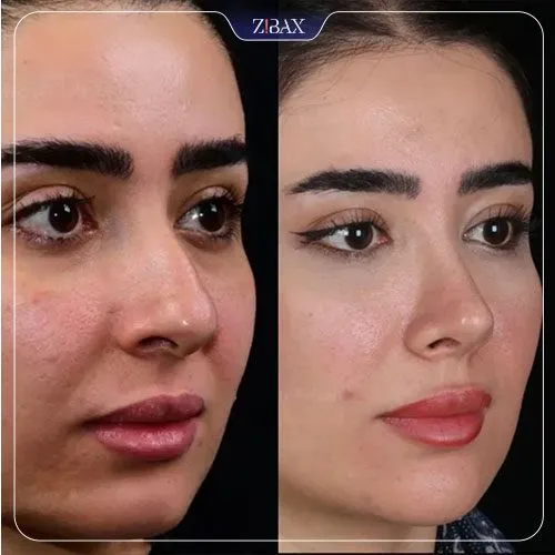 نمونه عمل جراحی بینی دکتر امین آمالی — تصویر 9