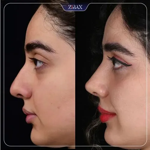 نمونه عمل جراحی بینی دکتر امین آمالی — تصویر 10