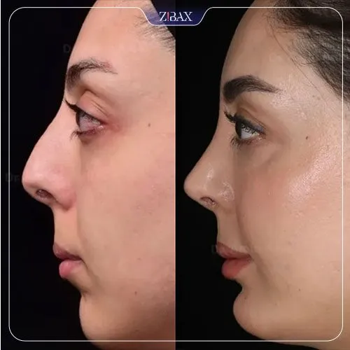 نمونه عمل جراحی بینی دکتر امین آمالی — تصویر 1